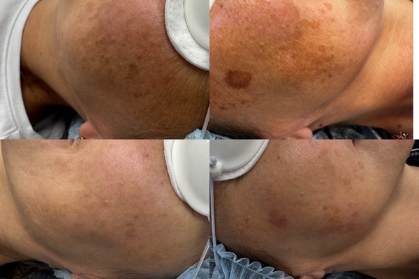 Уникальная процедура LUMECCA: обновите свою кожу за один сеанс.