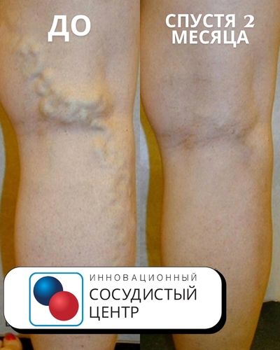 Избавление от варикоза: история пациентки с долгим опытом.