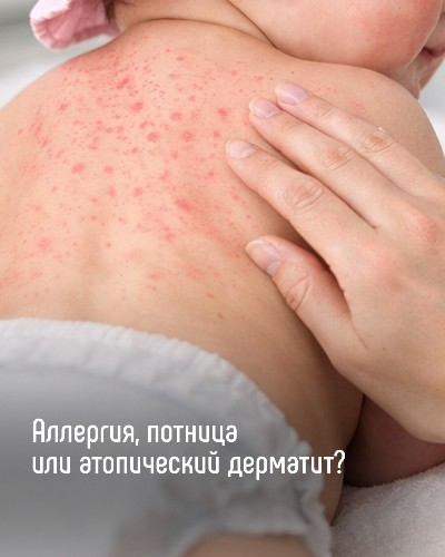 Аллергия, потница или атопический дерматит?